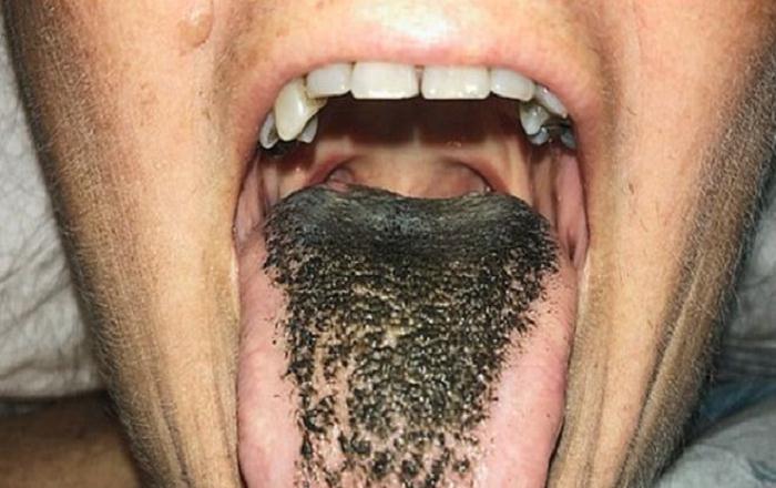 Un extraño trastorno médico le da una apariencia "peluda" a la lengua