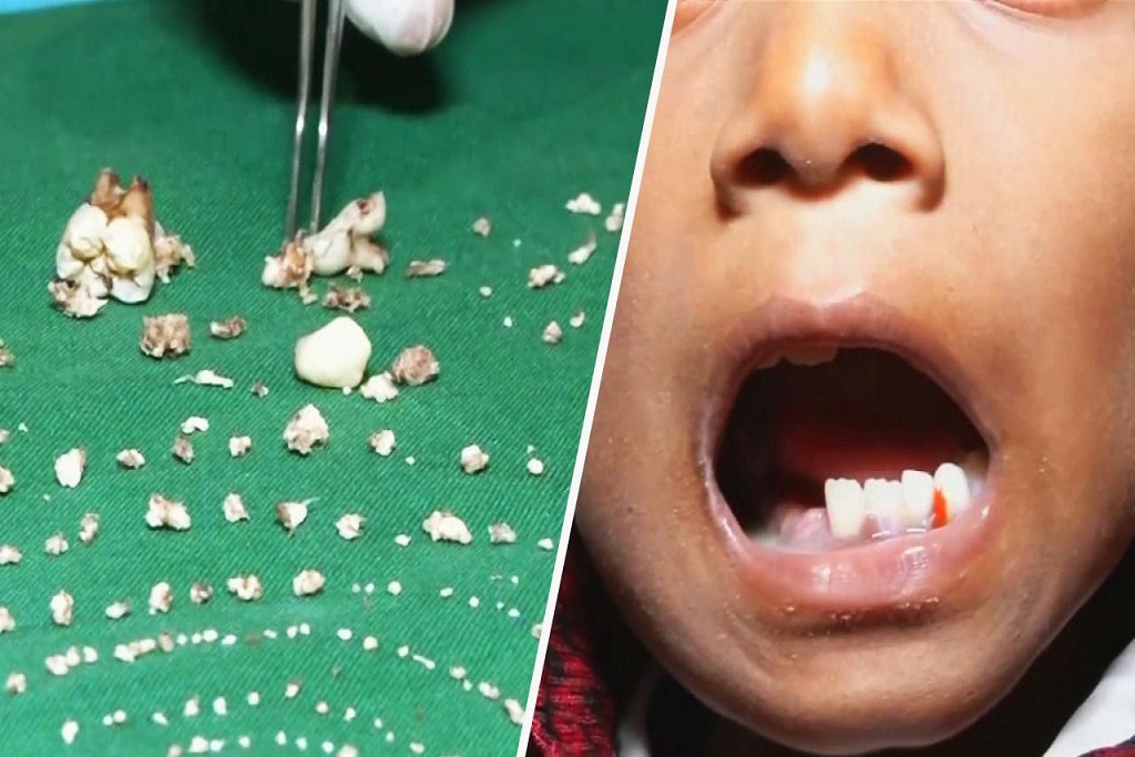 La máxima cantidad de dientes que alguien ha tenido. India y sus casos inusuales.