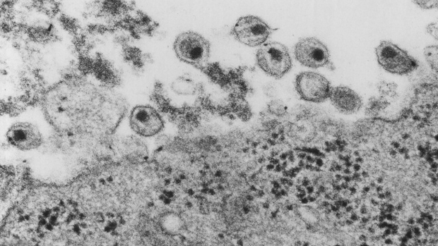 Virus del VIH visto desde un microscópio