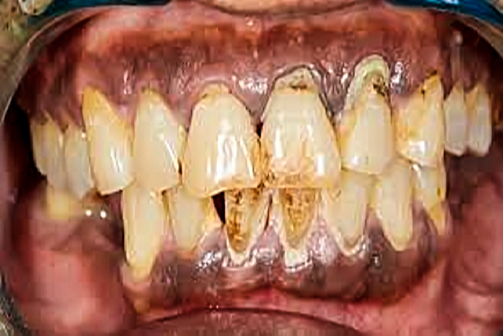 placas oscuras de los dientes