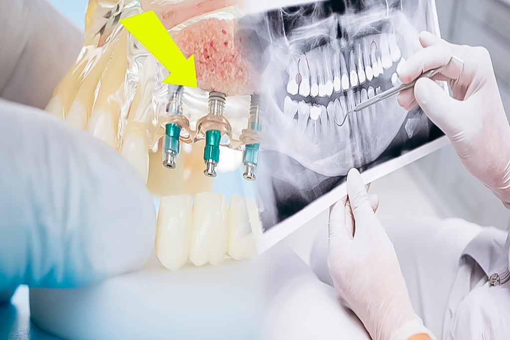 Las tecnologías más novedosas para los implantes dentales