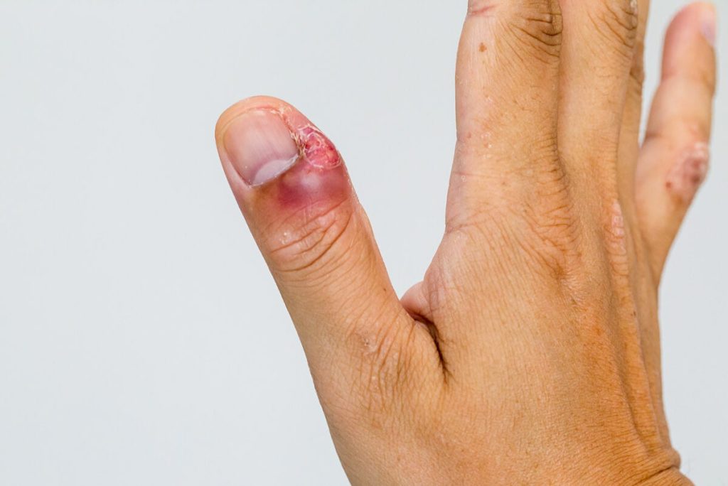 Enfermedades peligrosas para las uñas  