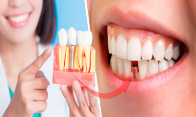 Avances científicos de los implantes dentales
