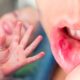 ¿Por qué el virus boca, manos y pies ataca más a los niños